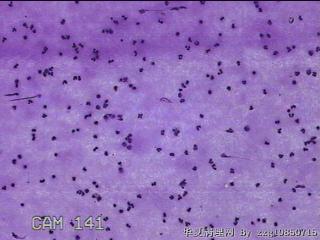 膝关节腔积液12ml图15
