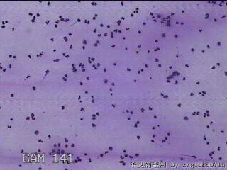 膝关节腔积液12ml图20