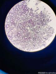 结肠多发息肉一年余，1.0*1.0cm，随访复查图8