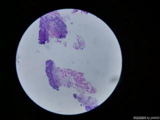 食管活检图9
