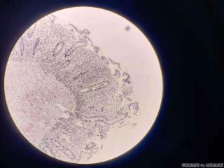 结肠赘生物图9