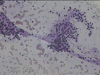 右侧甲状腺肿物细针穿刺涂片图28