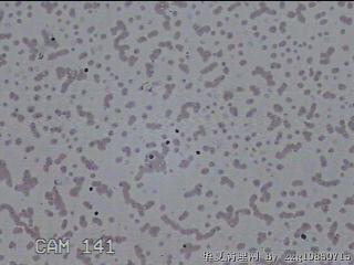 右侧甲状腺肿物细针穿刺涂片图5