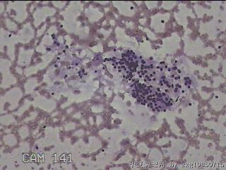右侧甲状腺肿物细针穿刺涂片图29