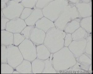 请老师看看臀部脂肪瘤图7