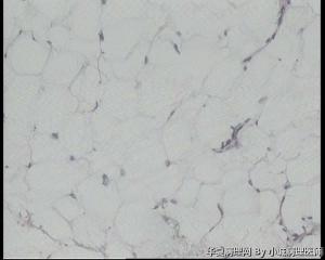 请老师看看臀部脂肪瘤图2