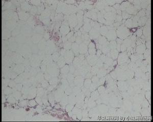 请老师看看臀部脂肪瘤图1