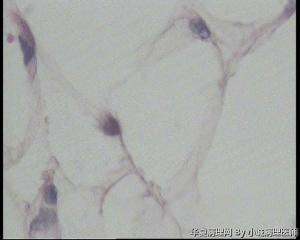 请老师看看臀部脂肪瘤图5