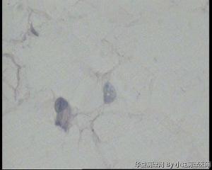 请老师看看臀部脂肪瘤图3