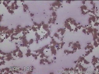 左侧甲状腺结节细针穿刺涂片图27
