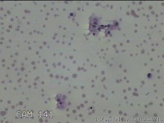 左侧甲状腺结节细针穿刺涂片图22