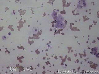 左侧甲状腺结节细针穿刺涂片图15