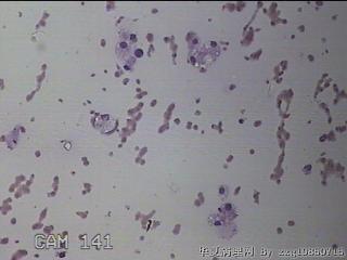 左侧甲状腺结节细针穿刺涂片图14
