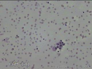 左侧甲状腺结节细针穿刺涂片图18