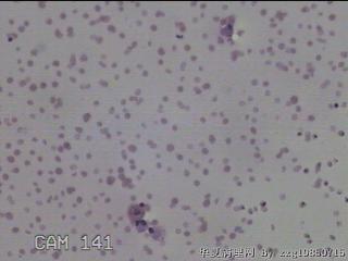 左侧甲状腺结节细针穿刺涂片图20
