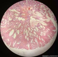 结肠息肉，诊断？（增生性息肉？炎性息肉？）图2