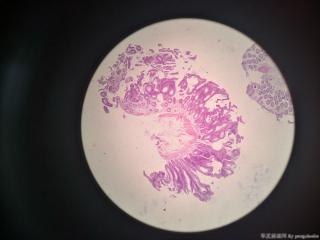 管状腺瘤伴低级别？图1