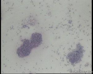 请老师会诊！腹水涂片，细胞蜡块，考虑卵巢癌吗？图1
