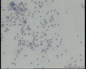 请老师会诊！腹水涂片，细胞蜡块，考虑卵巢癌吗？图4