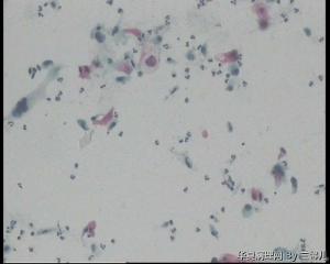 请老师看看，活检结果出来了，宫颈TCT，能直接报鳞癌细胞吗？图16