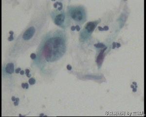 请老师看看，活检结果出来了，宫颈TCT，能直接报鳞癌细胞吗？图15