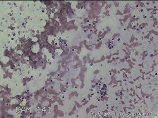 左侧甲状腺细针穿刺涂片图16