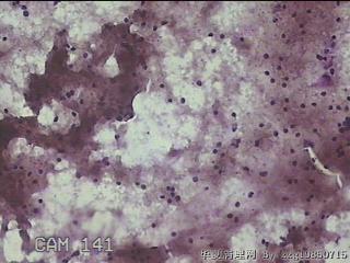 左侧甲状腺细针穿刺涂片图15
