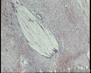 请老师看看双侧输卵管积脓图21