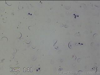左侧甲状腺细针穿刺涂片图13