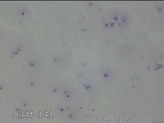 左侧甲状腺细针穿刺涂片图23
