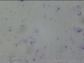 左侧甲状腺细针穿刺涂片图22