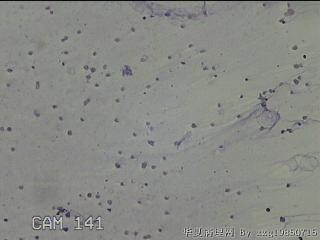左侧甲状腺细针穿刺涂片图24