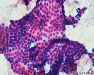 甲状腺穿刺图14