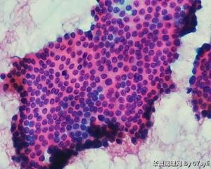 甲状腺穿刺图13