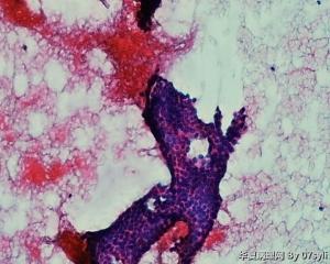 甲状腺穿刺图1