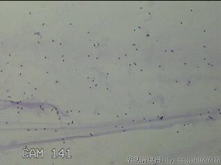 膝关节腔积液5ml图11