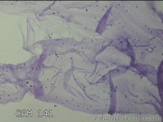膝关节腔积液5ml图26