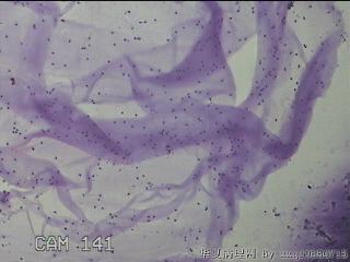 膝关节腔积液5ml图24