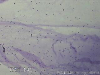 膝关节腔积液5ml图12