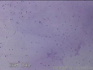 膝关节腔积液5ml图29