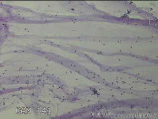 膝关节腔积液5ml图7