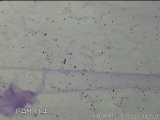 膝关节腔积液5ml图20