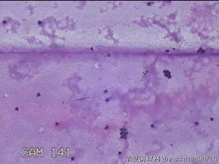 膝关节腔积液5ml图31