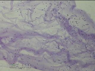 膝关节腔积液5ml图8