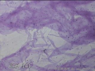 膝关节腔积液5ml图4