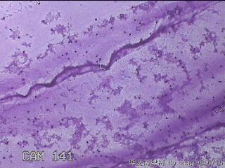 膝关节腔积液5ml图3