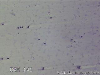 膝关节腔积液5ml图32