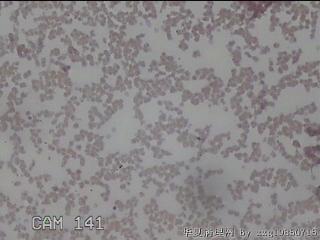 右侧甲状腺细针穿刺涂片图26