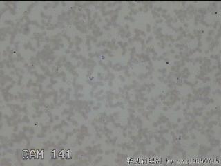 右侧甲状腺细针穿刺涂片图23