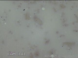 右侧甲状腺细针穿刺涂片图19